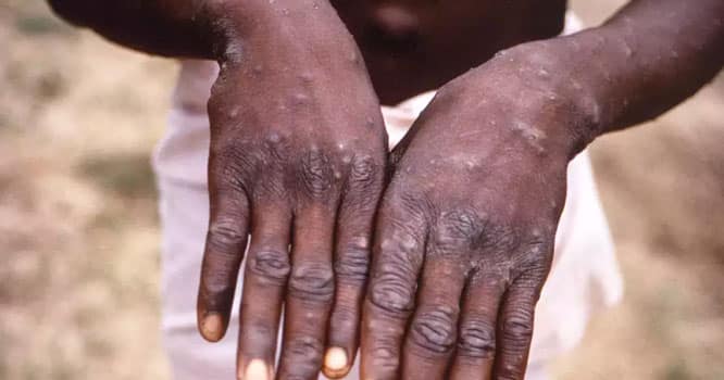 Pakistan reports 1st monkeypox case of 2024
