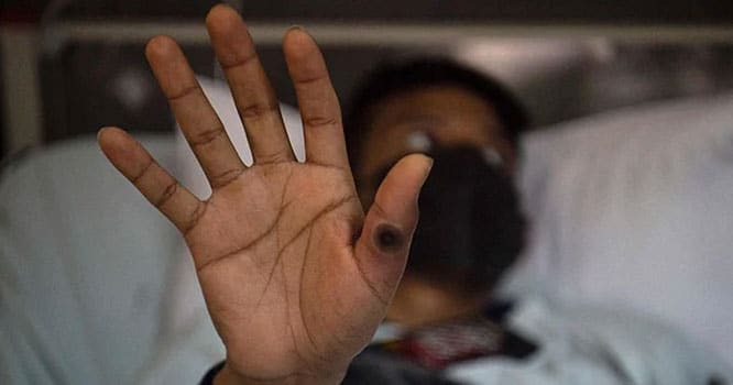 Sindh confirms first monkeypox case in Karachi