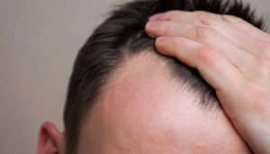 Scientists discover natural serum that reverses baldness, regrows hair