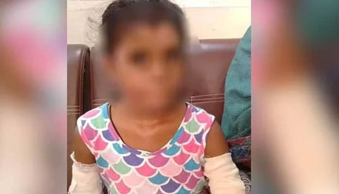 Stepfather sets 8-year-old daughter on fire in Karachi
