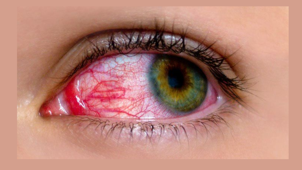 Conjunctivitis spreads in Pakistan: How to protect yourself from the highly contagious virus