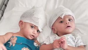 Conjoined twins successfully separated after 15-hour surgery in Saudi Arabia