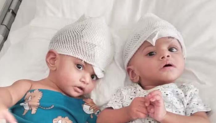 Conjoined twins successfully separated after 15-hour surgery in Saudi Arabia