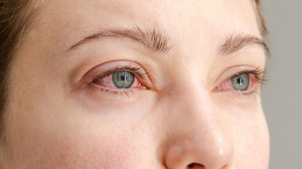 Pink eye virus surges in twin cities after rains